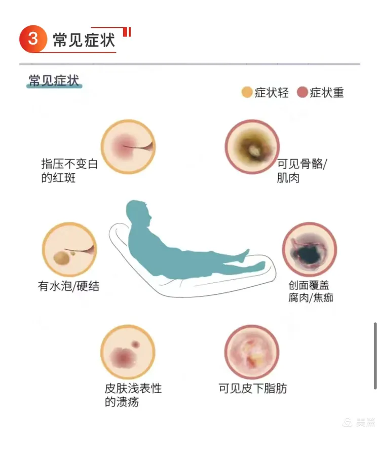 携手努力,共防压疮.世界压疮日,我们在行动